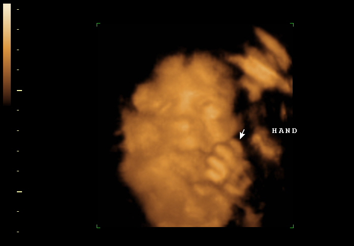 3D ultrasound image at 28 weeks